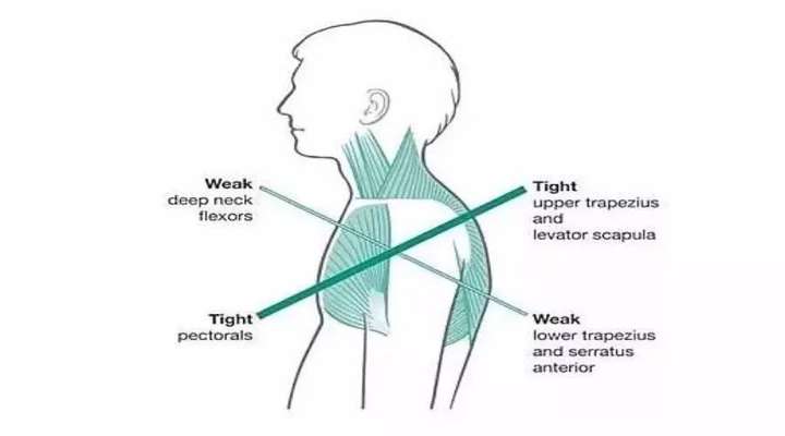 简单来说上交叉综合征就是 胸肌等肌群过度紧张及缩短,同时 背部肌群