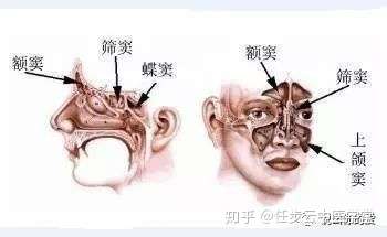 “戳穿”鼻炎真面目
