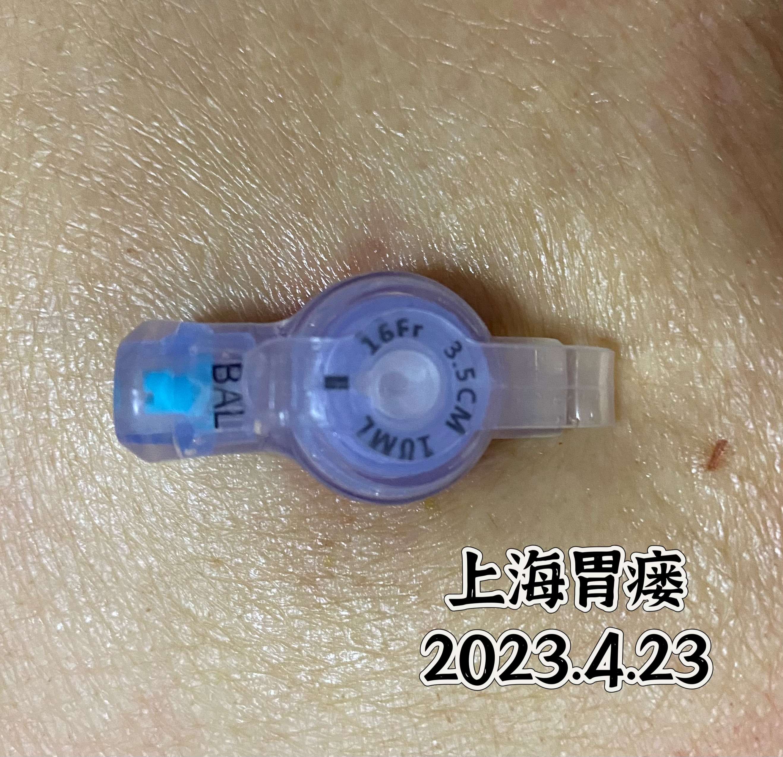 上海胃瘘 的想法: 短小精悍的纽扣管 | 食道癌患者胃造瘘术… - 知乎