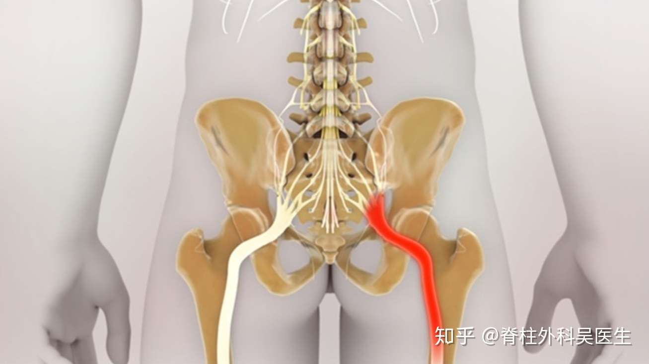 关于坐骨神经痛 你想要了解的都在这里了 知乎