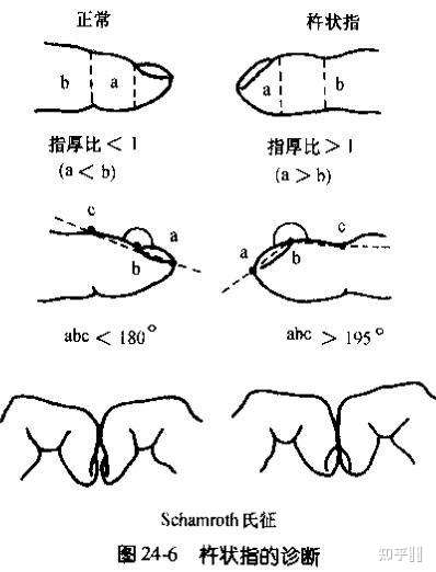 幫我看一下我這樣的是杵狀指嗎? - 知乎