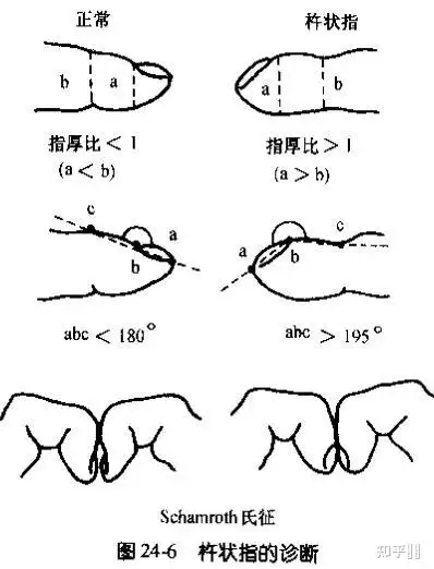 帮我看一下我这样的是杵状指吗? - 知乎