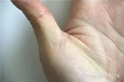 胃里有疾手掌会知手掌出现异常信号暗示胃受损需养胃