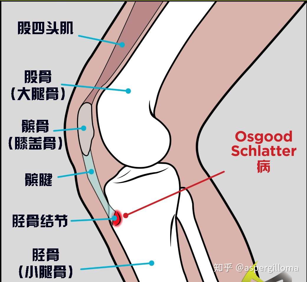 青少年运动后膝痛 家长别紧张 及时治疗 不会残疾 知乎