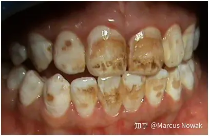 是什么导致牙齿变黑?