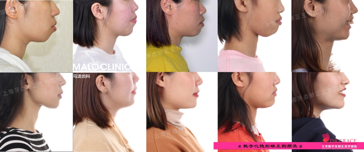 上海牙齿矫正 王芳院长 中国唯一的女性隐适美全球讲师 知乎 上海牙齿矫正 王芳院长 中国唯一的女性隐适美全球讲师 知乎