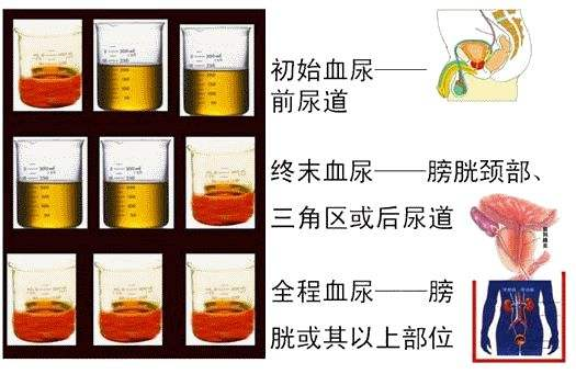 尿血是什么原因图片