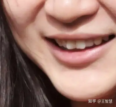 的错位的大牙~有一丝明显的八字门牙初中的时候曾经佩戴过一段时间的