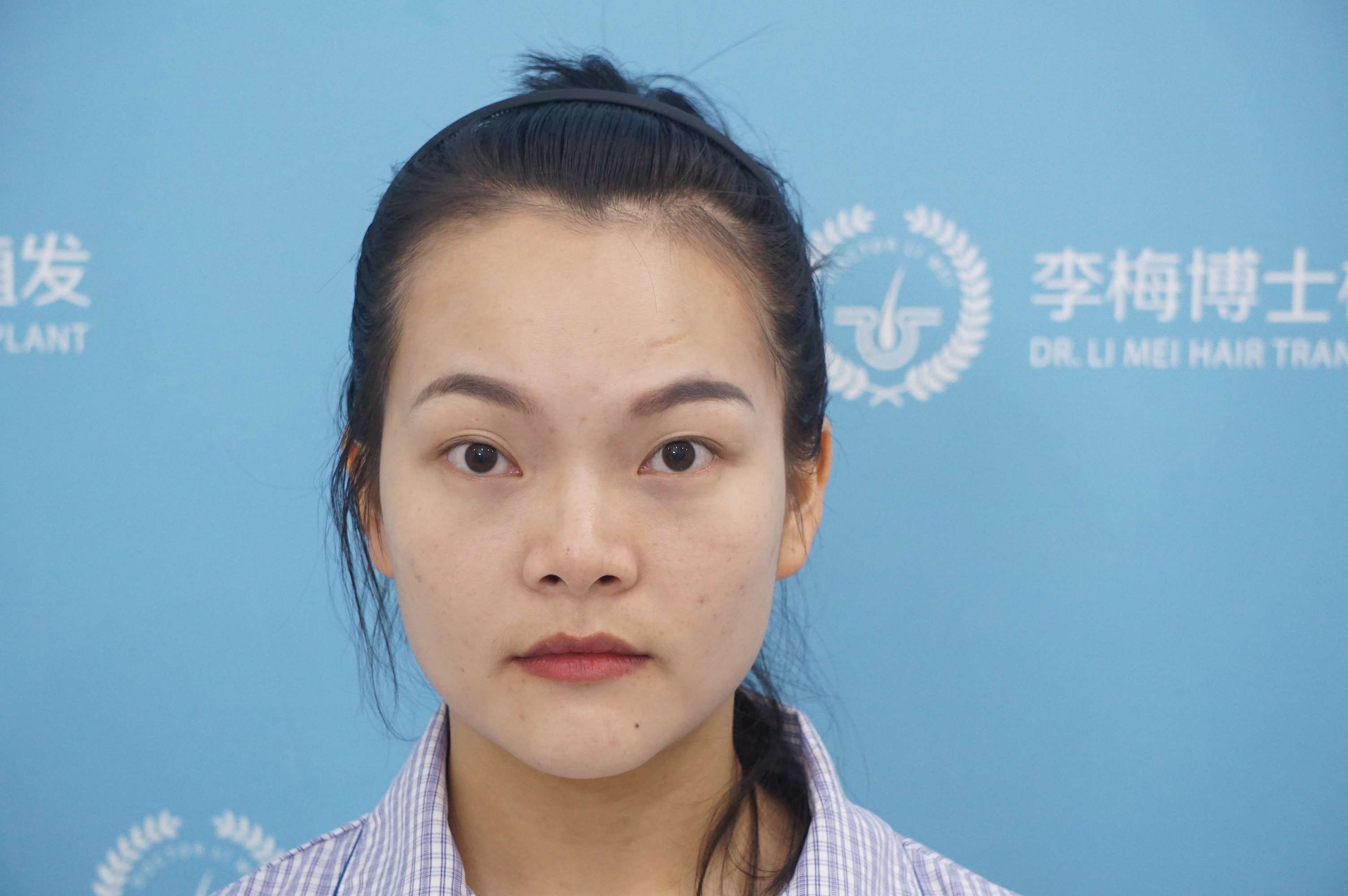 徐州植发美女(徐州脱发去哪个医院)