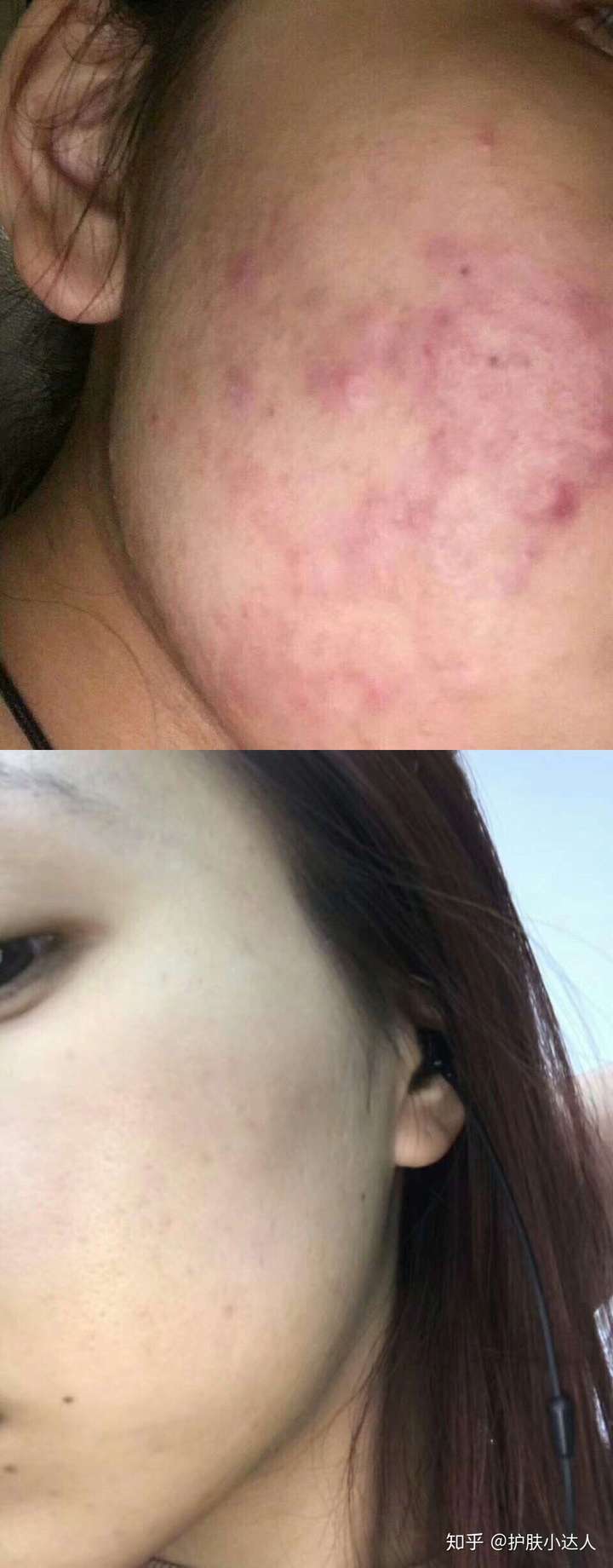 有哪些很神奇的祛痘印产品? - 知乎