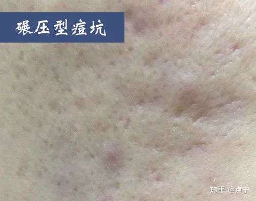 车厢型:在皮肤上底部面积比开口处小,边缘