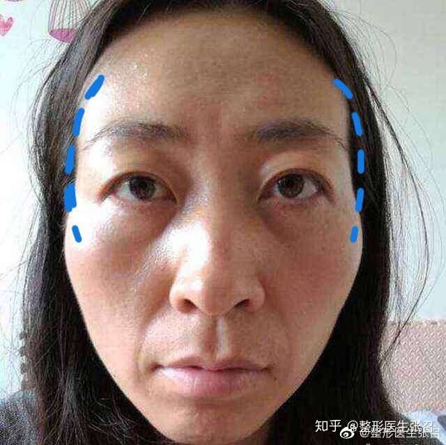 颧骨是什么地方能发图片指出来给我看看还有颧骨高什么意思?