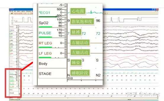 多导联睡眠呼吸监测psg解读 知乎