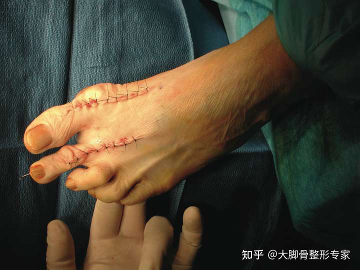 做大脚骨手术一定要上钢板吗？微创效果佳，恢复快