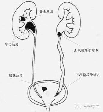 输尿管结石造成肾积水暂时又不想靠仪器取出让它自己排出来的可能性高