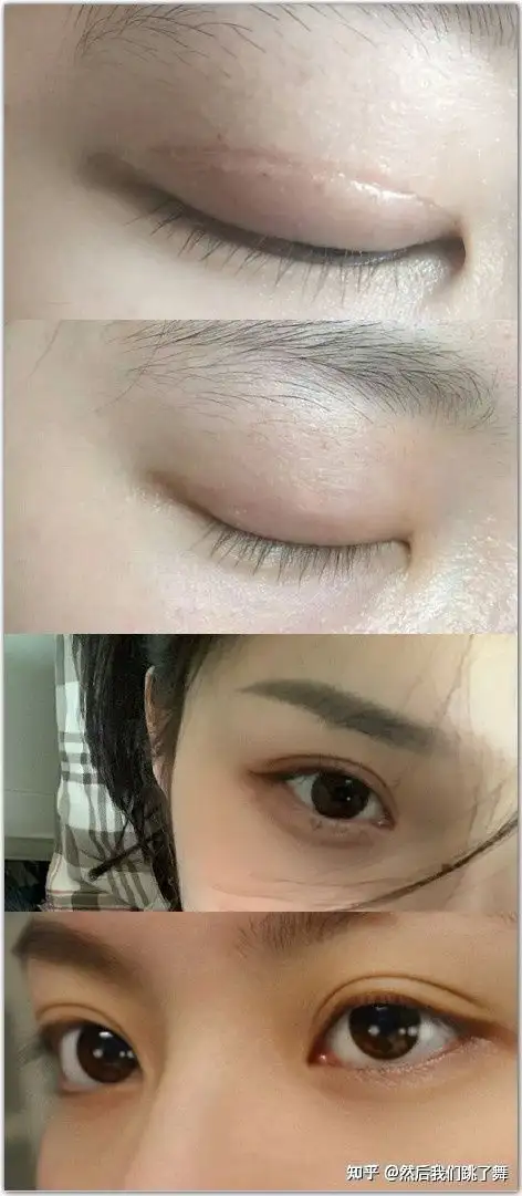 北京八大处成红雨的双眼皮做的怎么样？