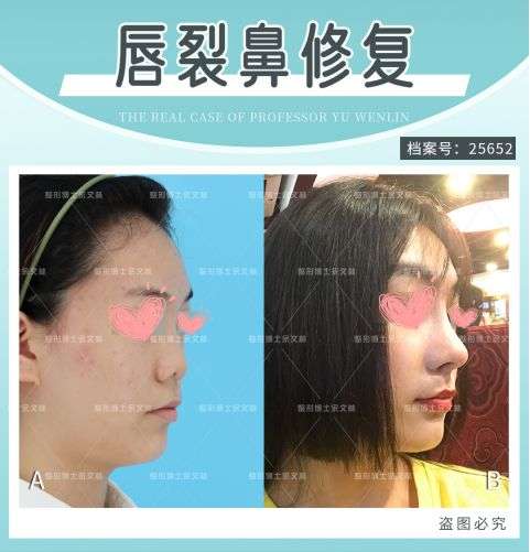 唇裂孩子为什么鼻子也塌了?专家提醒这个年龄快去修复!