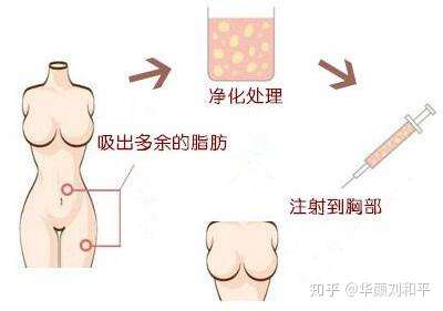 自体脂肪隆胸有哪些优点 知乎