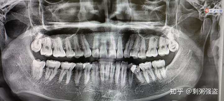 宁波这边哪个医院或者医生拔智齿比较好求推荐