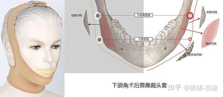 做下颌角整形手术前后要注意什么问题？