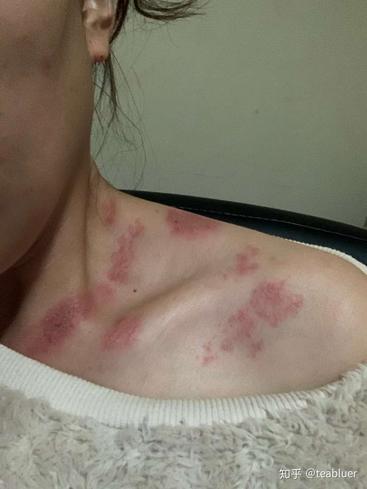 竟然得了带状疱疹