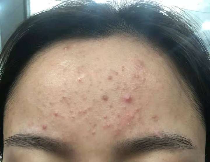 脸上痘痘太多了怎么办_如何快速祛痘的妙招学生