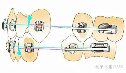 一根小钢丝正畸中却起着最大的作用