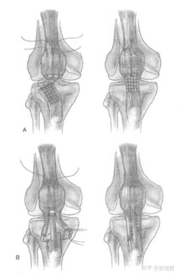 髌腱及股四头肌肌腱断裂修复术 天津艾柯特运动康复中心 知乎