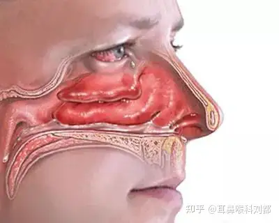 有什么缓解鼻塞的好办法