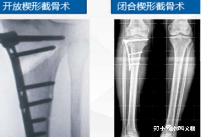 关于胫骨高位截骨术 Hto 你需要了解的八个问题 知乎