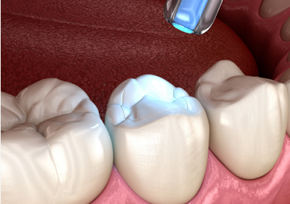 补牙、镶牙和种牙有什么区别？
