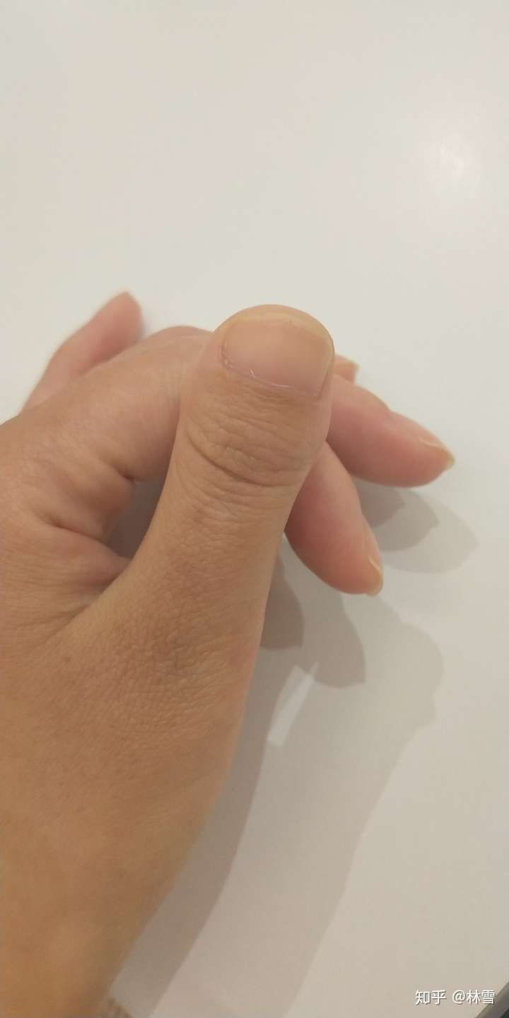 为什么我的大拇指又宽又短?