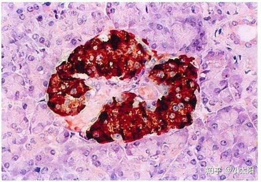 「2 型糖尿病」的病因主要是什么,如何诊断和预防?