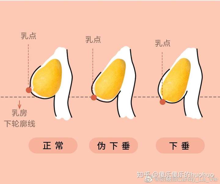 医学上对下垂的定义:乳点低于胸部下轮廓的位置才算哦～所以你不妨