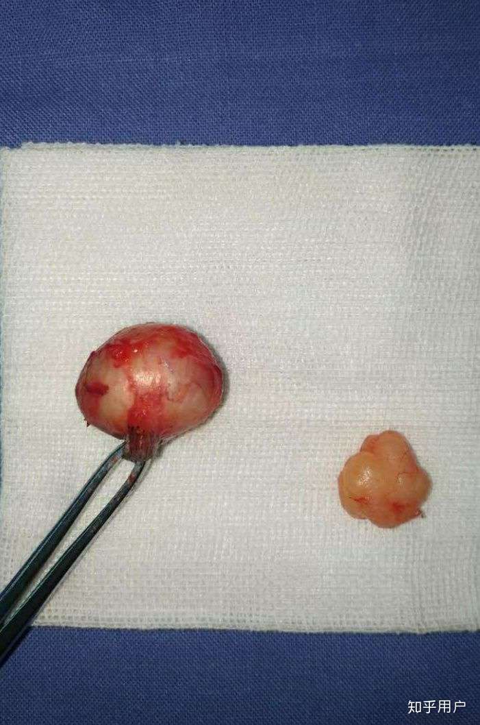 皮下脂肪瘤图片手术图片