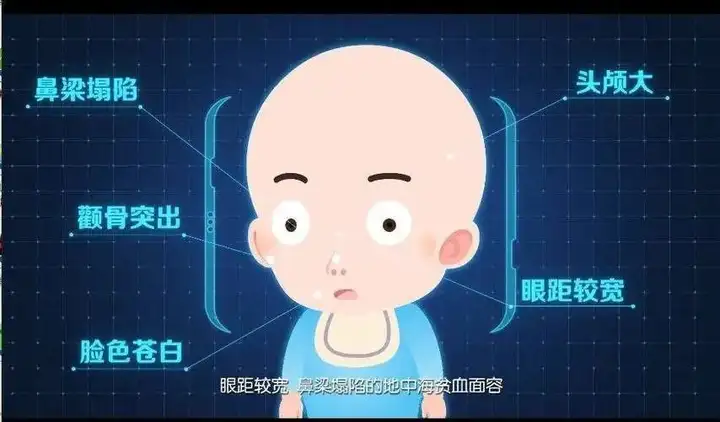 有:头大,眼距增宽,马鞍鼻,前额突出,两颊突出,其典型的表现是臀状头