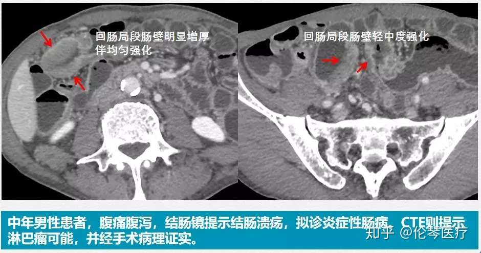 炎症性肠病为何需要影像学检查 看仁济医院教授怎么说 知乎