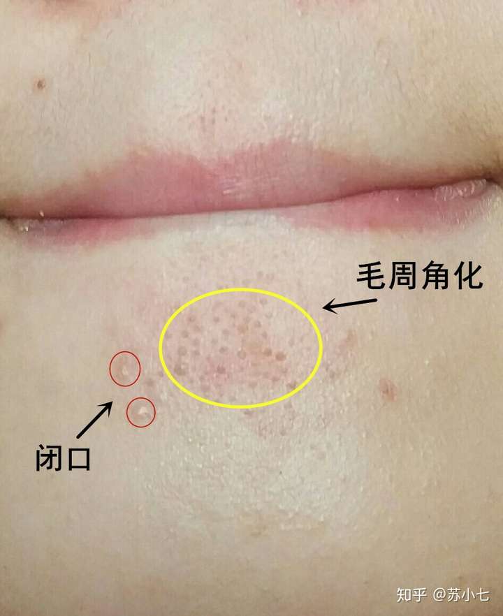 [图片] 几年来下巴反复长闭口粉刺,不抿嘴时不明显,阳光