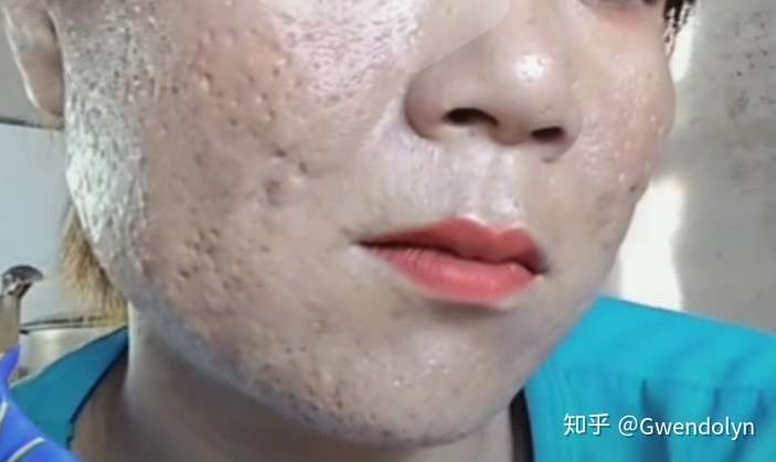 这样的毛孔要怎么办