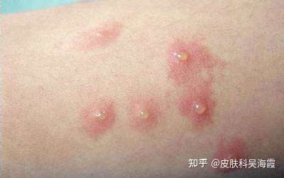 儿童尖锐湿疣的预防方法