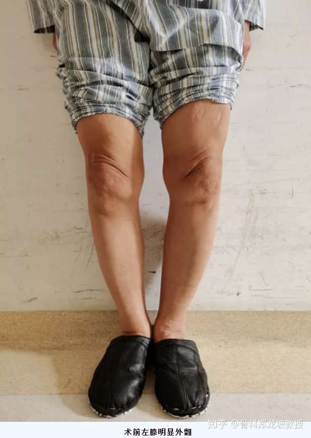 骨科郑龙坡教授 67 上海市第十人民医院骨科主任医师 专家简介