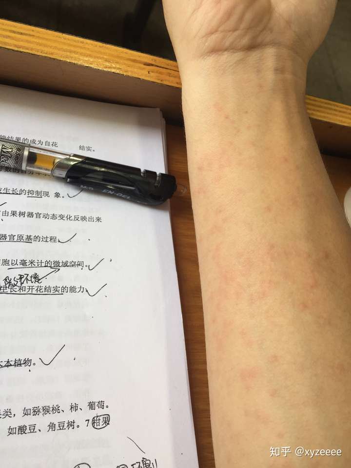 对自己的汗液过敏是什么体验?