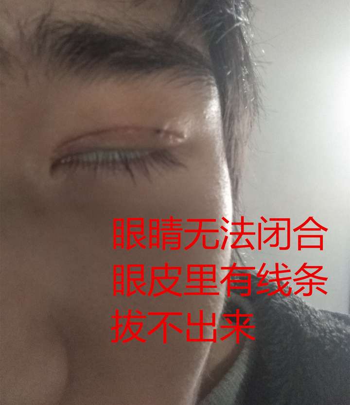 整容失败是种怎样的体验 知乎