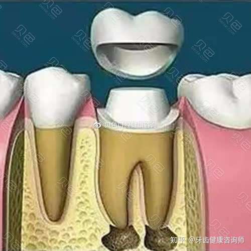 牙齒爛了個洞想補牙卻被醫生告知要做根管治療是想宰我錢