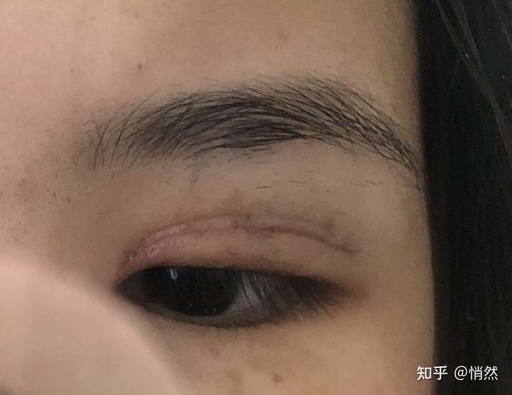 双眼皮术后15天褶皱和刀口不重合眼尾分出两道痕迹自己可以做什么补救