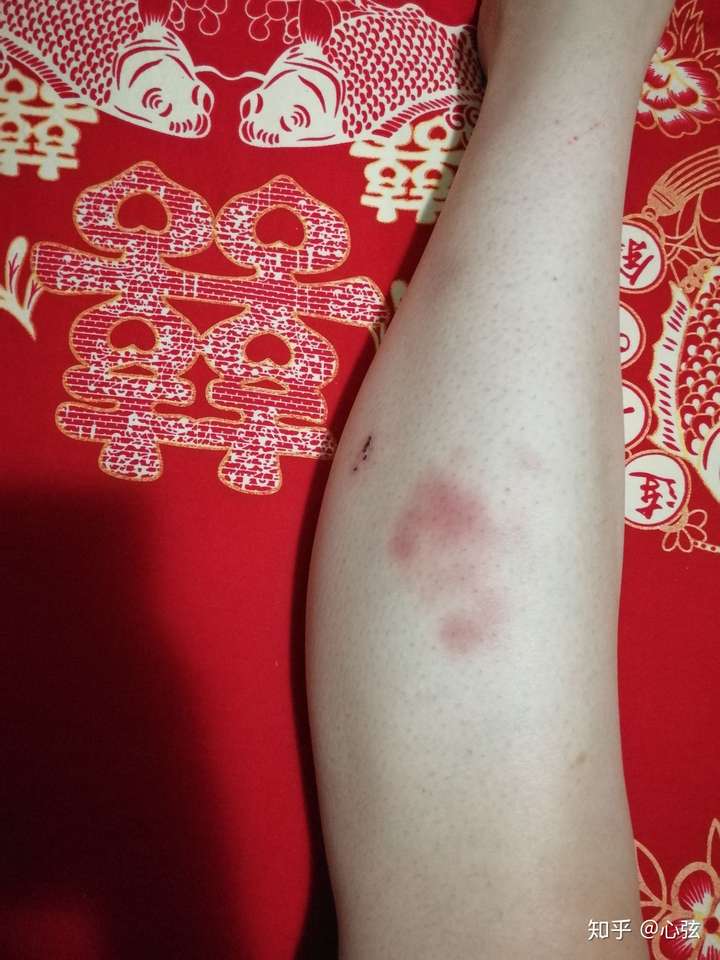 请问使用泡沫轴按摩大腿外侧时,出现这样的淤青正常么?
