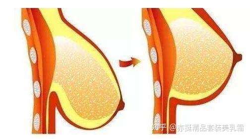 哺乳后如何丰胸?胸部有些下垂了,想改善?