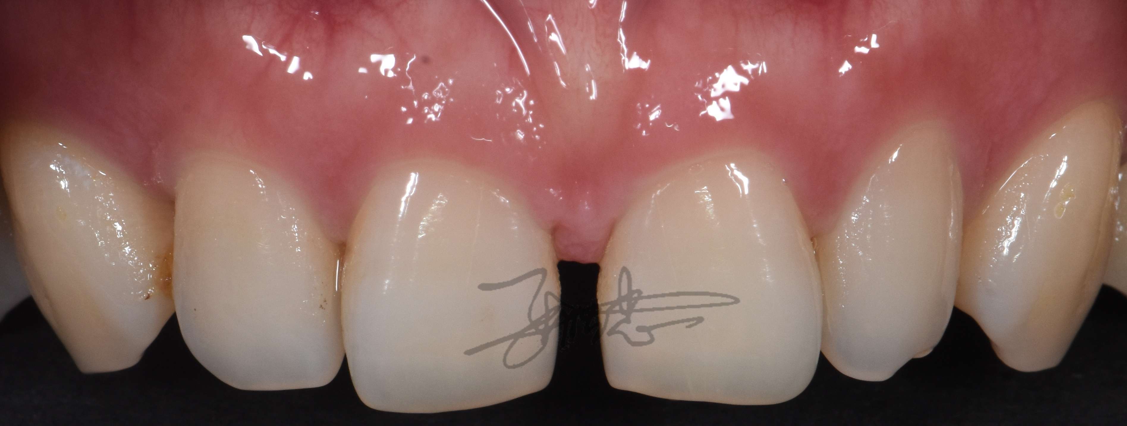 牙科张医生 的想法: 用树脂关闭门牙缝,也是一个很不错的方式 - 知乎