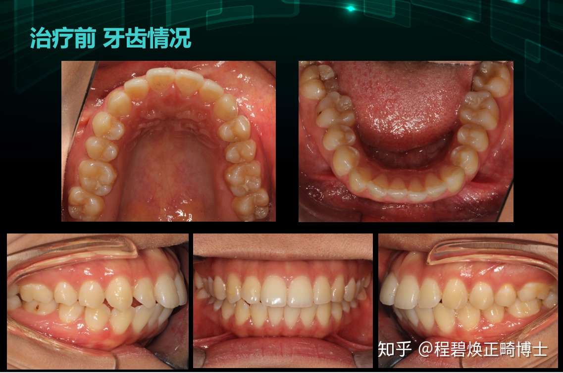 隐适美复杂病例 双颌前突 拔牙 骨钉 知乎