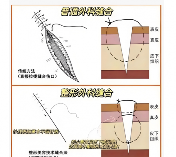 海宁JN江南登录康华医院新设美容外科美容缝合：让伤口“无痕”